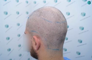 Injerto Capilar Técnica FUE Grafts 5158 (11924 Pelos) 23 31 DISENO LINEA DE INJERTO