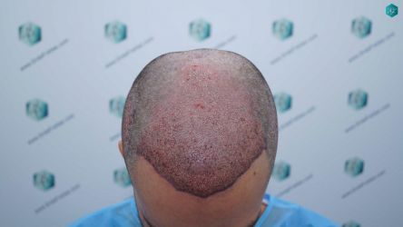 PRIMERA CIRUGIA CAPILAR 35 TRASPLANTE CAPILAR