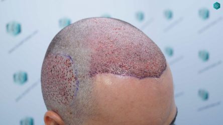 Injerto Capilar Técnica FUE Grafts 5158 (11924 Pelos) 24 38 TRASPLANTE CAPILAR
