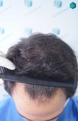 Injerto Capilar Técnica FUE Grafts 5158 (11924 Pelos) 3 4 ANTES DEL TRASPLANTE CAPILAR