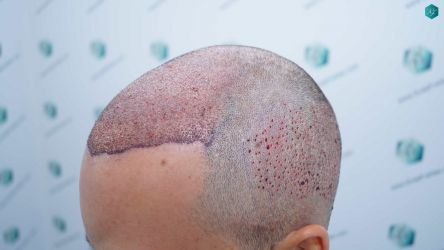 Injerto Capilar Técnica FUE Grafts 5158 (11924 Pelos) 25 40 TRASPLANTE CAPILAR
