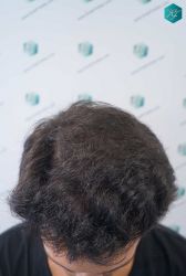 Injerto Capilar Técnica FUE Grafts 5158 (11924 Pelos) 27 49 RESULTADOS A LOS 12 MESES