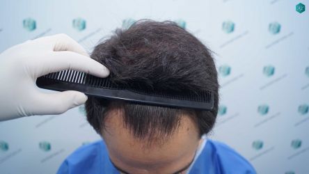 Injerto Capilar Técnica FUE Grafts 5158 (11924 Pelos) 4 5 ANTES DEL TRASPLANTE CAPILAR