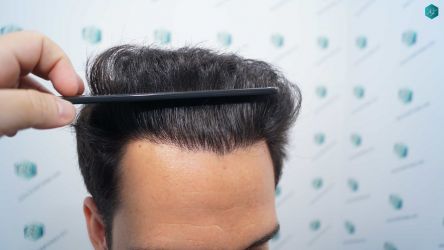 Injerto Capilar Técnica FUE Grafts 5158 (11924 Pelos) 28 51 RESULTADOS A LOS 12 MESES