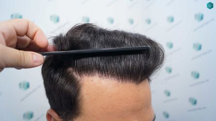 Injerto Capilar Técnica FUE Grafts 5158 (11924 Pelos) 29 51A RESULTADOS A LOS 12 MESES