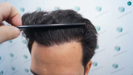 Injerto Capilar Técnica FUE Grafts 5158 (11924 Pelos) 30 52 RESULTADOS A LOS 12 MESES