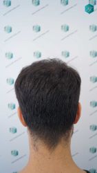 Injerto Capilar Técnica FUE Grafts 5158 (11924 Pelos) 31 53 RESULTADOS A LOS 12 MESES