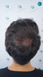 Injerto Capilar Técnica FUE Grafts 5158 (11924 Pelos) 32 54 RESULTADOS A LOS 12 MESES