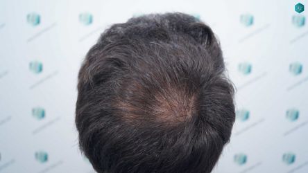 Injerto Capilar Técnica FUE Grafts 5158 (11924 Pelos) 33 55 RESULTADOS A LOS 12 MESES