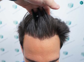 Injerto Capilar Técnica FUE Grafts 5158 (11924 Pelos) 34 58 ANTES DEL TRASPLANTE CAPILAR
