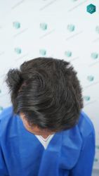 Injerto Capilar Técnica FUE Grafts 5158 (11924 Pelos) 35 59 ANTES DEL TRASPLANTE CAPILAR