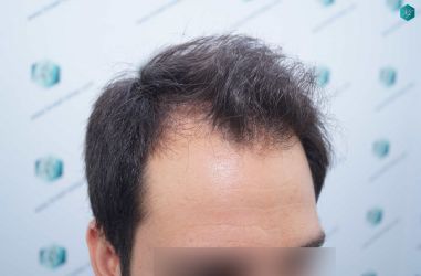 Injerto Capilar Técnica FUE Grafts 5158 (11924 Pelos) 5 6 ANTES DEL TRASPLANTE CAPILAR