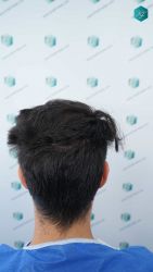 Injerto Capilar Técnica FUE Grafts 5158 (11924 Pelos) 36 60 ANTES DEL TRASPLANTE CAPILAR