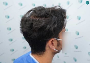 Injerto Capilar Técnica FUE Grafts 5158 (11924 Pelos) 38 62 ANTES DEL TRASPLANTE CAPILAR
