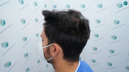 Injerto Capilar Técnica FUE Grafts 5158 (11924 Pelos) 39 63 ANTES DEL TRASPLANTE CAPILAR