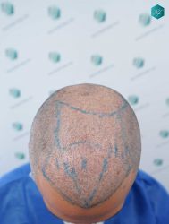 Injerto Capilar Técnica FUE Grafts 5158 (11924 Pelos) 40 66 DISENO LINEA DE INJERTO CAPILAR