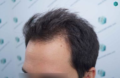 Injerto Capilar Técnica FUE Grafts 5158 (11924 Pelos) 6 7 ANTES DEL TRASPLANTE CAPILAR