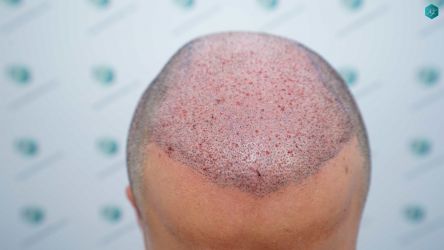 Injerto Capilar Técnica FUE Grafts 5158 (11924 Pelos) 42 74 TRASPLANTE CAPILAR