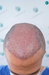 Injerto Capilar Técnica FUE Grafts 5158 (11924 Pelos) 43 74A TRASPLANTE CAPILAR