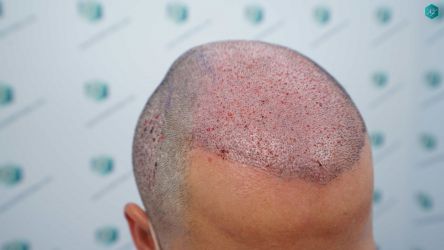 Injerto Capilar Técnica FUE Grafts 5158 (11924 Pelos) 44 75 TRASPLANTE CAPILAR