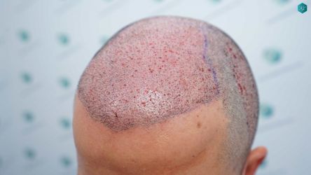 Injerto Capilar Técnica FUE Grafts 5158 (11924 Pelos) 45 76 TRASPLANTE CAPILAR