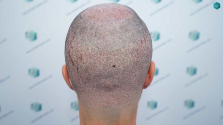 Injerto Capilar Técnica FUE Grafts 5158 (11924 Pelos) 46 77 TRASPLANTE CAPILAR