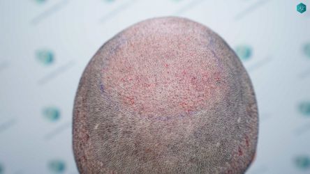 Injerto Capilar Técnica FUE Grafts 5158 (11924 Pelos) 48 79 TRASPLANTE CAPILAR