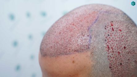 Injerto Capilar Técnica FUE Grafts 5158 (11924 Pelos) 50 84B TRASPLANTE CAPILAR
