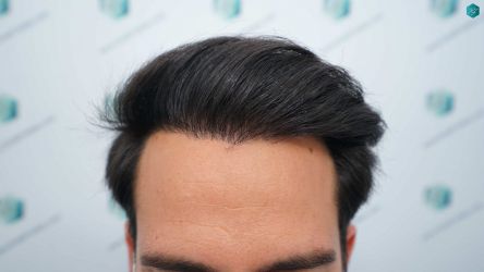 Injerto Capilar Técnica FUE Grafts 5158 (11924 Pelos) 51 88AB RESULTADOS A LOS 12 MESES