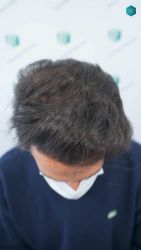 Injerto Capilar Técnica FUE Grafts 5158 (11924 Pelos) 52 88ABC RESULTADOS A LOS 12 MESES