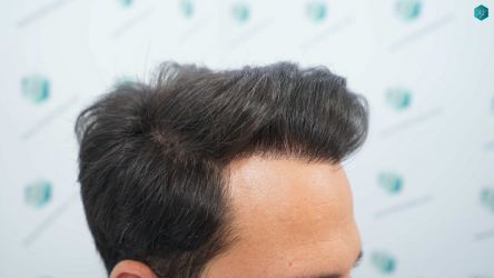 Injerto Capilar Técnica FUE Grafts 5158 (11924 Pelos) 53 88BC RESULTADOS A LOS 12 MESES