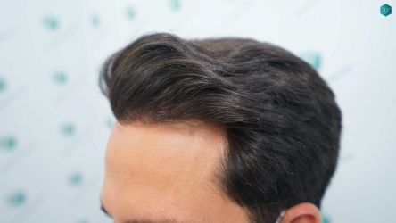 Injerto Capilar Técnica FUE Grafts 5158 (11924 Pelos) 54 88BCD RESULTADOS A LOS 12 MESES