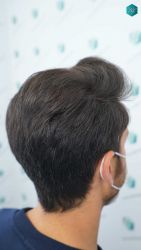 Injerto Capilar Técnica FUE Grafts 5158 (11924 Pelos) 55 88BCDE RESULTADOS A LOS 12 MESES