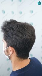 Injerto Capilar Técnica FUE Grafts 5158 (11924 Pelos) 56 88BCDEF RESULTADOS A LOS 12 MESES