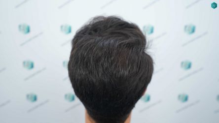 Injerto Capilar Técnica FUE Grafts 5158 (11924 Pelos) 57 89 RESULTADOS A LOS 12 MESES