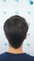 Injerto Capilar Técnica FUE Grafts 5158 (11924 Pelos) 58 89A RESULTADOS A LOS 12 MESES