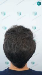 Injerto Capilar Técnica FUE Grafts 5158 (11924 Pelos) 59 89B RESULTADOS A LOS 12 MESES