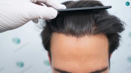 Injerto Capilar Técnica FUE Grafts 5158 (11924 Pelos) 60 90 RESULTADOS A LOS 12 MESES