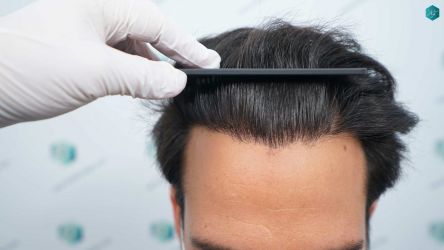 Injerto Capilar Técnica FUE Grafts 5158 (11924 Pelos) 61 91 RESULTADOS A LOS 12 MESES