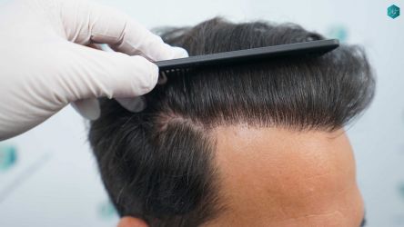 Injerto Capilar Técnica FUE Grafts 5158 (11924 Pelos) 62 98 RESULTADOS A LOS 12 MESES