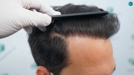 Injerto Capilar Técnica FUE Grafts 5158 (11924 Pelos) 63 99 RESULTADOS A LOS 12 MESES