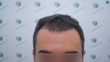 Injerto Capilar Técnica FUE Grafts 2945 (6960 Pelos) 8 10 DISENO LINEA INJERTO CAPILAR