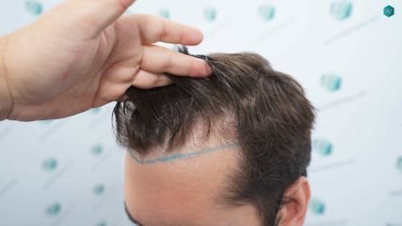 Injerto Capilar Técnica FUE Grafts 2117 (5025 Pelos) 8 10 LINEA DISENO INJERTO
