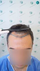 Injerto Capilar Técnica FUE Grafts 2945 (6960 Pelos) 9 10A DISENO LINEA INJERTO CAPILAR