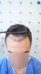 Injerto Capilar Técnica FUE Grafts 2945 (6960 Pelos) 10 10B DISENO LINEA INJERTO CAPILAR
