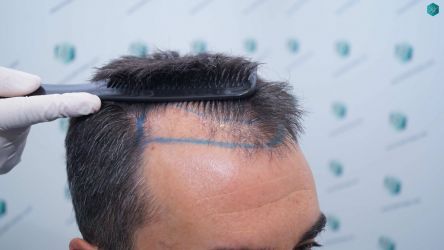 Injerto Capilar Técnica FUE Grafts 2945 (6960 Pelos) 11 11 DISENO LINEA INJERTO CAPILAR