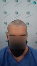 Injerto Capilar Técnica FUE Grafts 2117 (5025 Pelos) 9 11 LINEA DISENO INJERTO