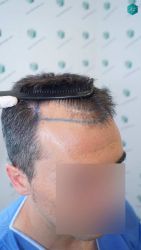 Injerto Capilar Técnica FUE Grafts 2945 (6960 Pelos) 12 12 DISENO LINEA INJERTO CAPILAR