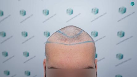 Injerto Capilar Técnica FUE Grafts 2117 (5025 Pelos) 10 12 LINEA DISENO INJERTO