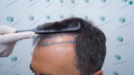 Injerto Capilar Técnica FUE Grafts 2945 (6960 Pelos) 13 13 DISENO LINEA INJERTO CAPILAR